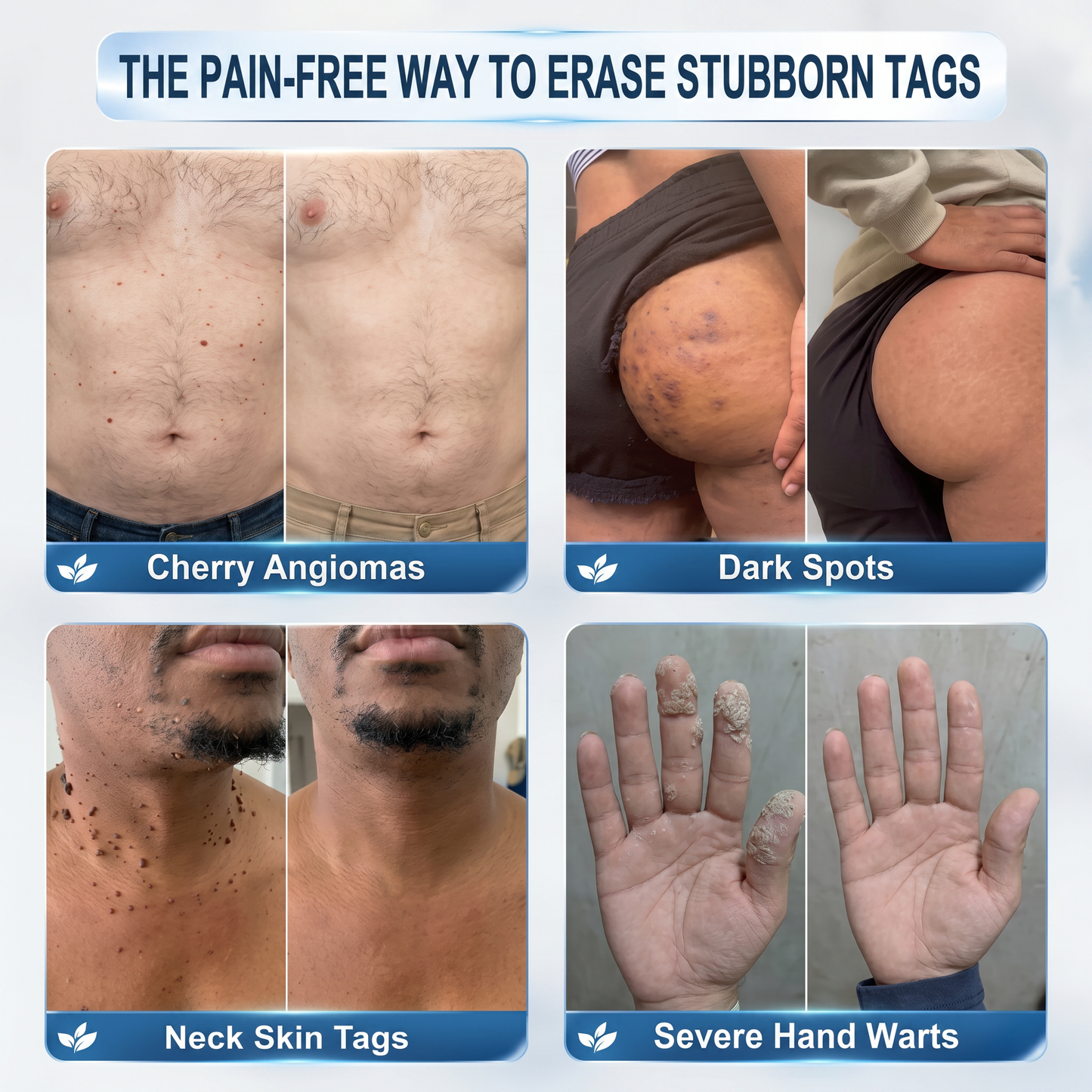 Authorized Brand Store✨|🌥️𝐕𝐢𝐭𝐚𝐥𝐢𝐬𝐲𝐬® 7-𝐷𝑎𝑦 𝗧𝐚𝐠 & 𝗦𝗽𝐨𝐭 𝐄𝐫𝒂𝒔𝒆𝒓(Zero Pain, Zero 𝐒𝐜𝐚𝒓𝒔 Rollerball)💟